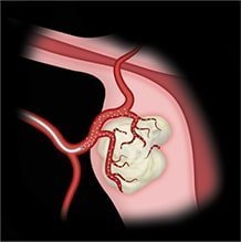 uterine fibroid treatment ECCO Medical