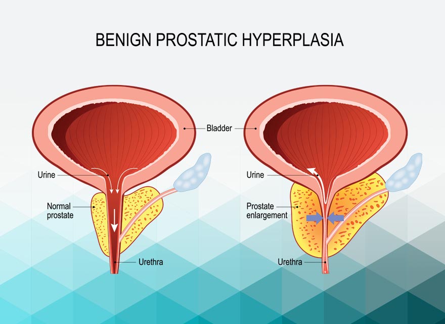 Does low testosterone cause prostate enlargement