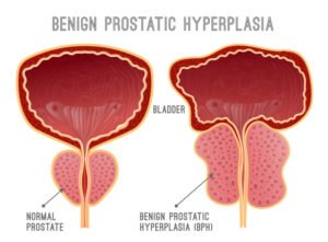 enlarged prostate treatment options
