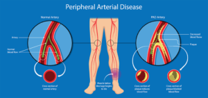 Peripheral_Arterial_Disease-Treatment
