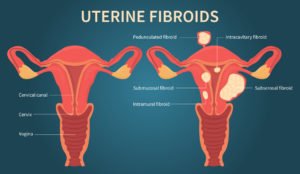 UFE uterine fibroids Embolization Treatment Procedure
