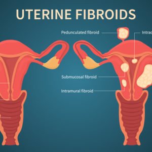 UFE uterine fibroids Embolization