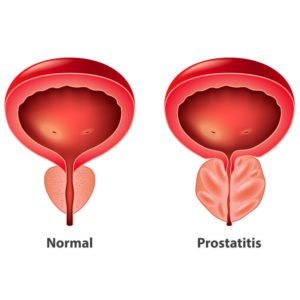 Prostate embolization treatments options enlarged normal