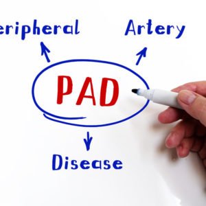 Peripheral Artery Disease PAD Treatments Denver