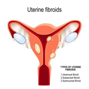 uterine fibroids clinics treatment