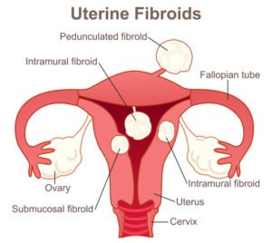 Uterine fibroides for women treatment