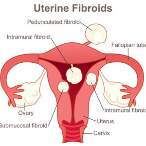 Uterine fibroides for women treatment