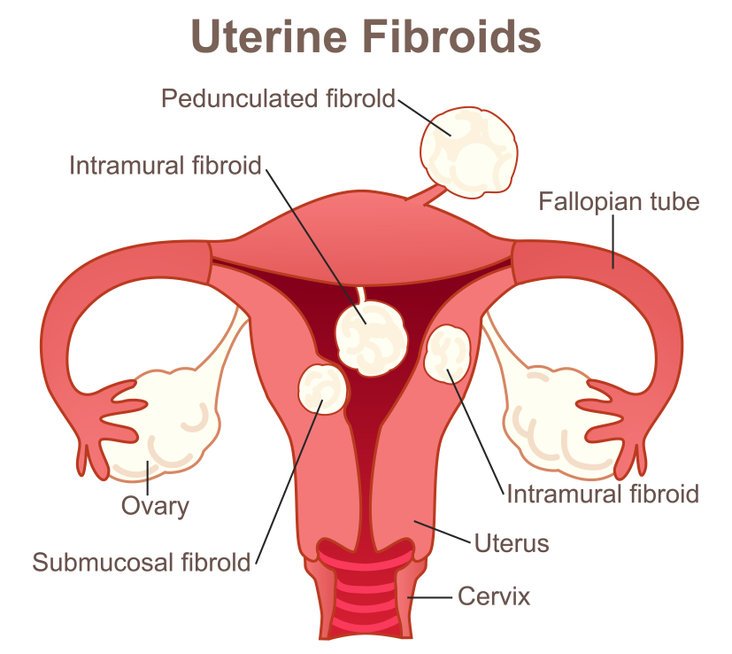 Tracking The Most Severe Complications Of Uterine Fibroids Ecco Endovascular Consultants