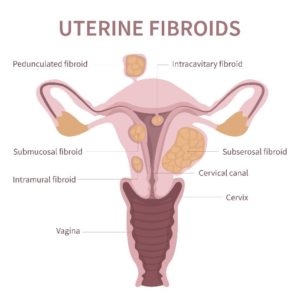uterine fibroids colorado treatments detection