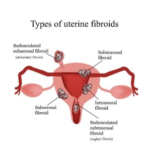 uterine fibroids treatment frequent urination problem