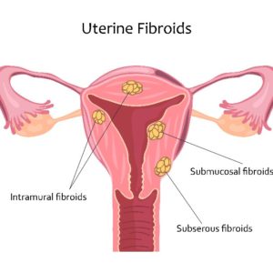 uterine fibroids treatment Denver clinic