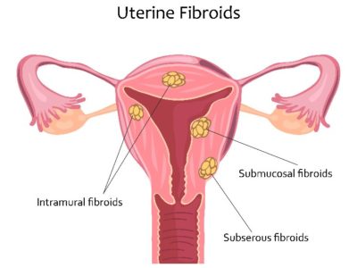 uterine fibroids treatment Denver clinic