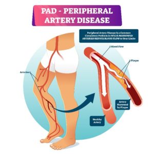 Leg Pain Treatment PAD Clinic Doctors